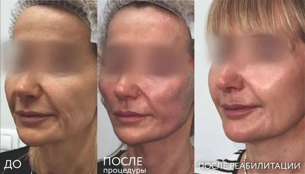 КЛИНИКА СКВ объявляет набор моделей на неделю нитевого лифтинга после снижения веса
